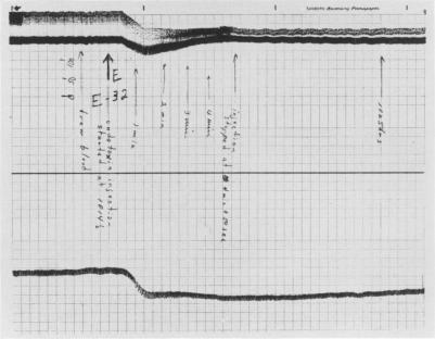 https://cdn.ncbi.nlm.nih.gov/pmc/blobs/7f02/1465952/25b924b28ce4/annsurg00859-0061-b.jpg