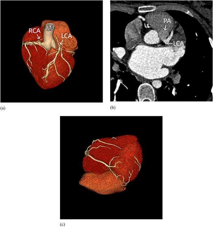 https://cdn.ncbi.nlm.nih.gov/pmc/blobs/7f54/12104172/0d5cdfa88ddd/fcvm-12-1573539-g003.jpg