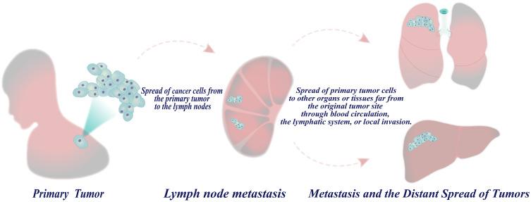 https://cdn.ncbi.nlm.nih.gov/pmc/blobs/7f6b/12077412/96eb54cb3594/CMAR-17-933-g0006.jpg