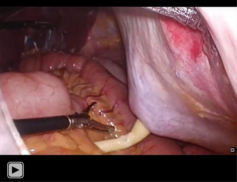 https://cdn.ncbi.nlm.nih.gov/pmc/blobs/80ce/10186509/d00a118af6c2/jgo-14-02-617-vid1.jpg