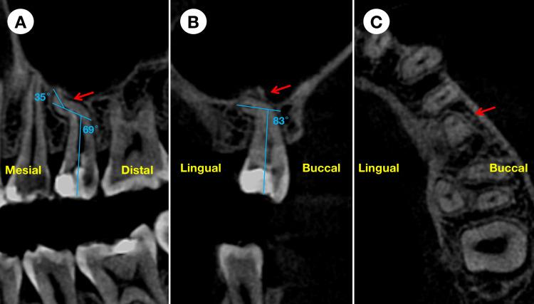 https://cdn.ncbi.nlm.nih.gov/pmc/blobs/80f6/11144437/5736aefb5ecf/cureus-0016-00000059590-i02.jpg