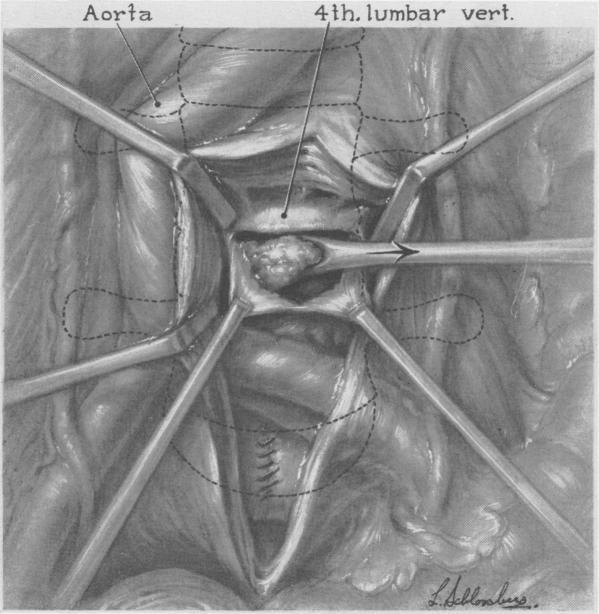https://cdn.ncbi.nlm.nih.gov/pmc/blobs/810d/1513826/1b08ca6ca5fc/annsurg01360-0166-a.jpg