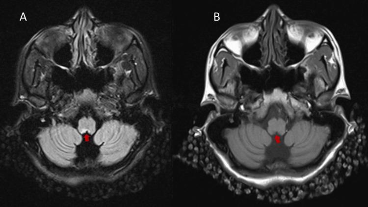 https://cdn.ncbi.nlm.nih.gov/pmc/blobs/813c/12115988/2fdd5e61d57b/cureus-0017-00000083092-i01.jpg
