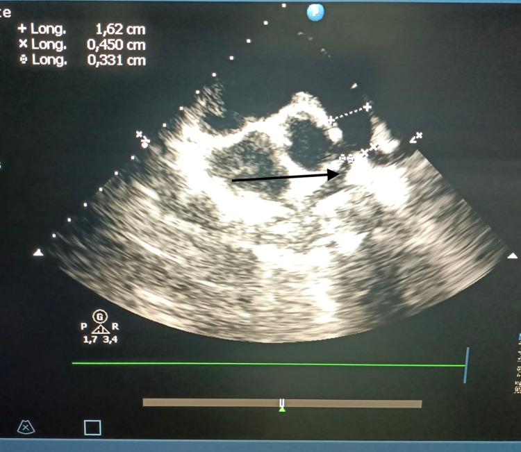 https://cdn.ncbi.nlm.nih.gov/pmc/blobs/8148/9167490/716c22335949/cureus-0014-00000024773-i02.jpg