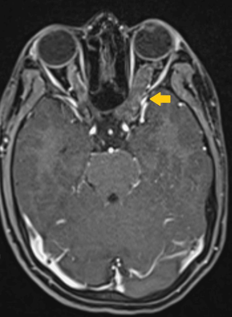 https://cdn.ncbi.nlm.nih.gov/pmc/blobs/814d/12207188/80a61cd479c8/cureus-0017-00000085112-i02.jpg