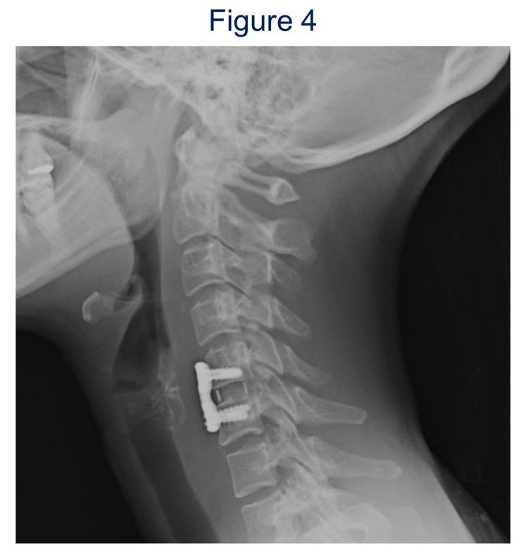 https://cdn.ncbi.nlm.nih.gov/pmc/blobs/8158/8384399/5a198e82b6a0/cureus-0013-00000016633-i04.jpg