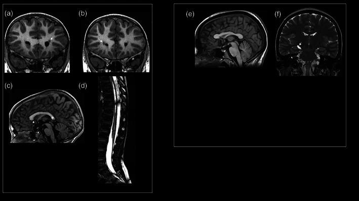 https://cdn.ncbi.nlm.nih.gov/pmc/blobs/8200/10091694/eea9a8c7b31f/AJMG-191-540-g002.jpg