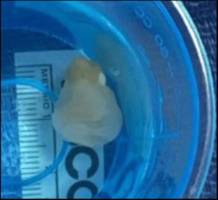 https://cdn.ncbi.nlm.nih.gov/pmc/blobs/8232/12136720/e58f17f6701d/cureus-0017-00000083527-i05.jpg