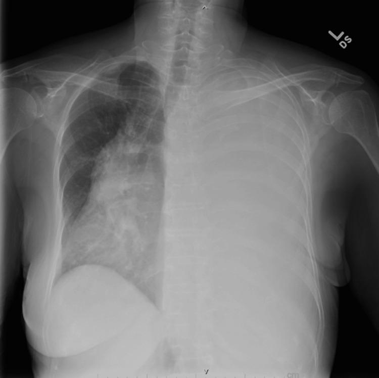 https://cdn.ncbi.nlm.nih.gov/pmc/blobs/82ec/12086292/ac3feb59a51f/cureus-0017-00000082551-i01.jpg