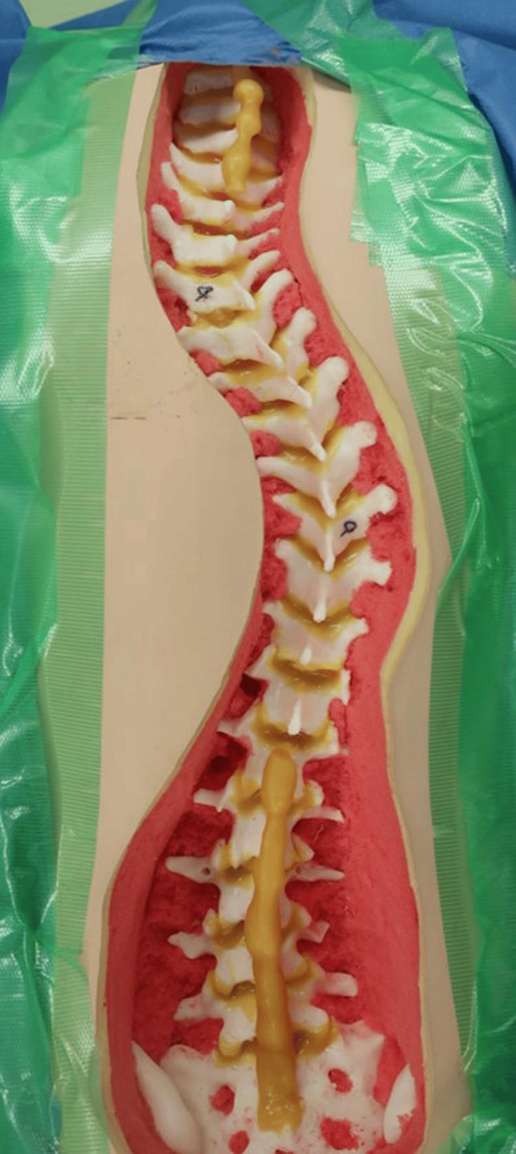 https://cdn.ncbi.nlm.nih.gov/pmc/blobs/82fd/11133951/cafa4edb44bf/cureus-0016-00000059240-i04.jpg