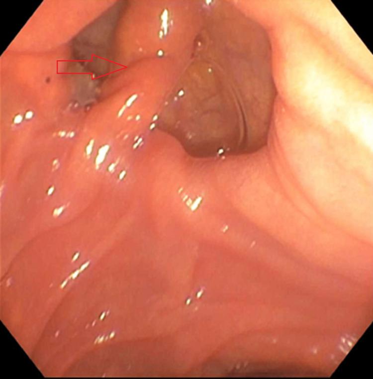 https://cdn.ncbi.nlm.nih.gov/pmc/blobs/8332/10105574/3edd778dbaf7/cureus-0015-00000036236-i02.jpg