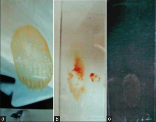 https://cdn.ncbi.nlm.nih.gov/pmc/blobs/837a/10810072/ee27f51ad958/JCytol-41-22-g001.jpg