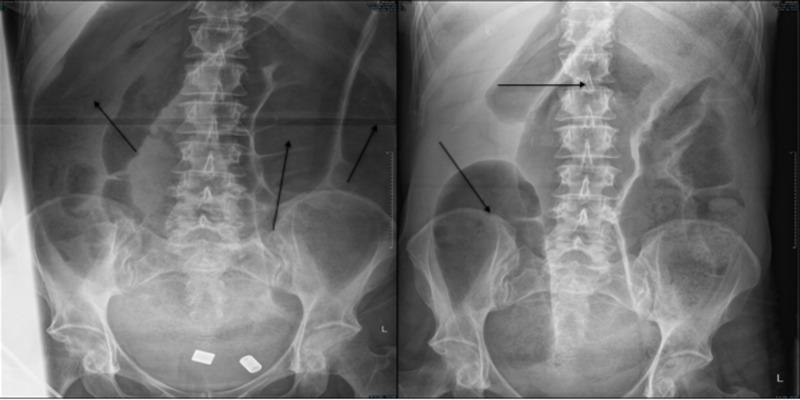 https://cdn.ncbi.nlm.nih.gov/pmc/blobs/8422/7714735/96d70a7f075e/cureus-0012-00000011839-i04.jpg