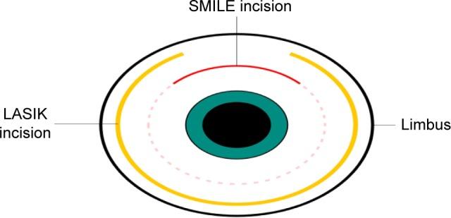 https://cdn.ncbi.nlm.nih.gov/pmc/blobs/8480/5608083/daf4655c825a/opth-11-1683Fig1.jpg