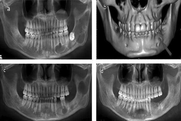 https://cdn.ncbi.nlm.nih.gov/pmc/blobs/8484/6667002/4aea7b6ecc7b/medoral-24-e491-g003.jpg