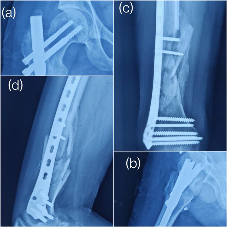 https://cdn.ncbi.nlm.nih.gov/pmc/blobs/84a1/8383820/6fa447e27c95/cureus-0013-00000016613-i03.jpg