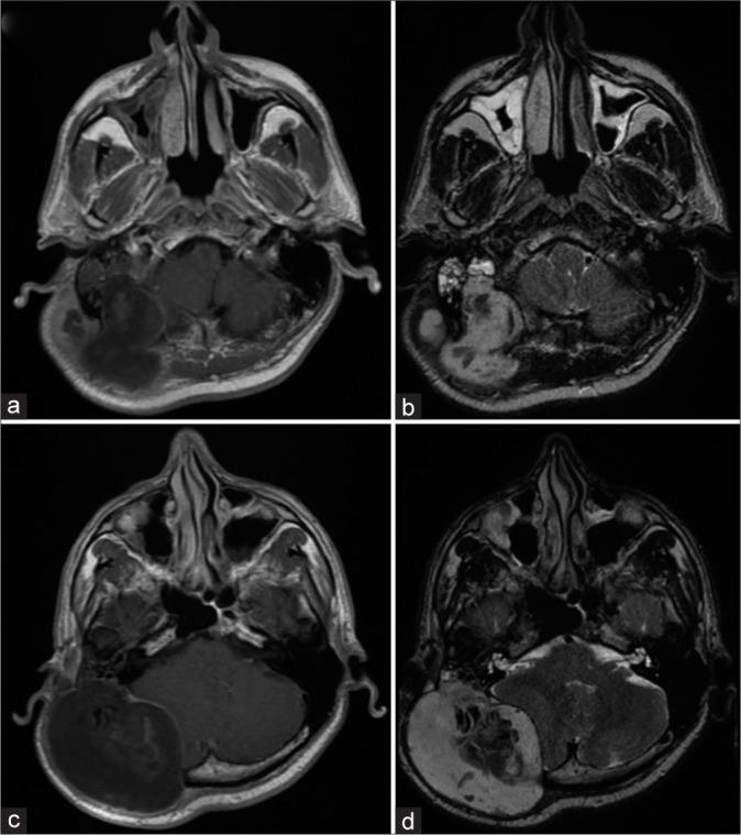 https://cdn.ncbi.nlm.nih.gov/pmc/blobs/84c3/11021098/5b4540eb6f9f/SNI-15-89-g002.jpg