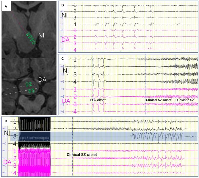 https://cdn.ncbi.nlm.nih.gov/pmc/blobs/84e9/7493627/6a338562966c/fneur-11-00965-g0003.jpg