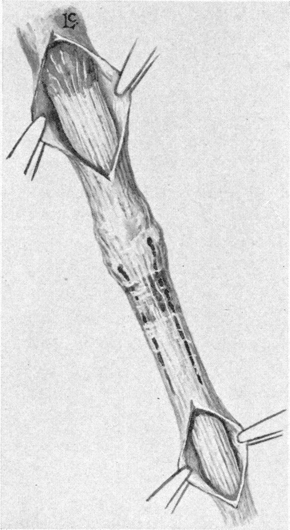 https://cdn.ncbi.nlm.nih.gov/pmc/blobs/84ed/1385702/5cf338db1c65/annsurg00387-0139-b.jpg