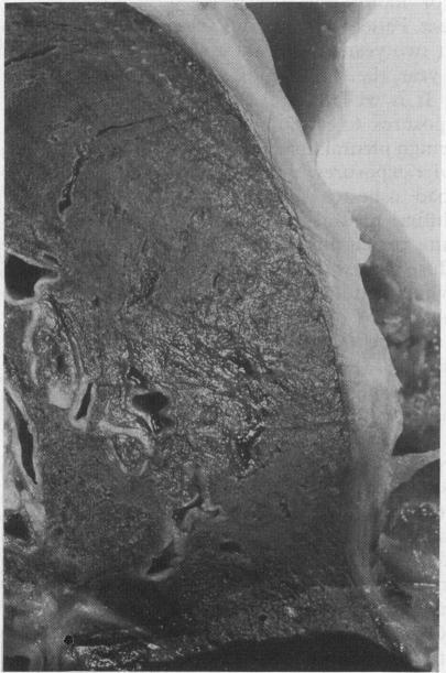 https://cdn.ncbi.nlm.nih.gov/pmc/blobs/8506/463190/86a84dcb2710/thorax00354-0031-b.jpg
