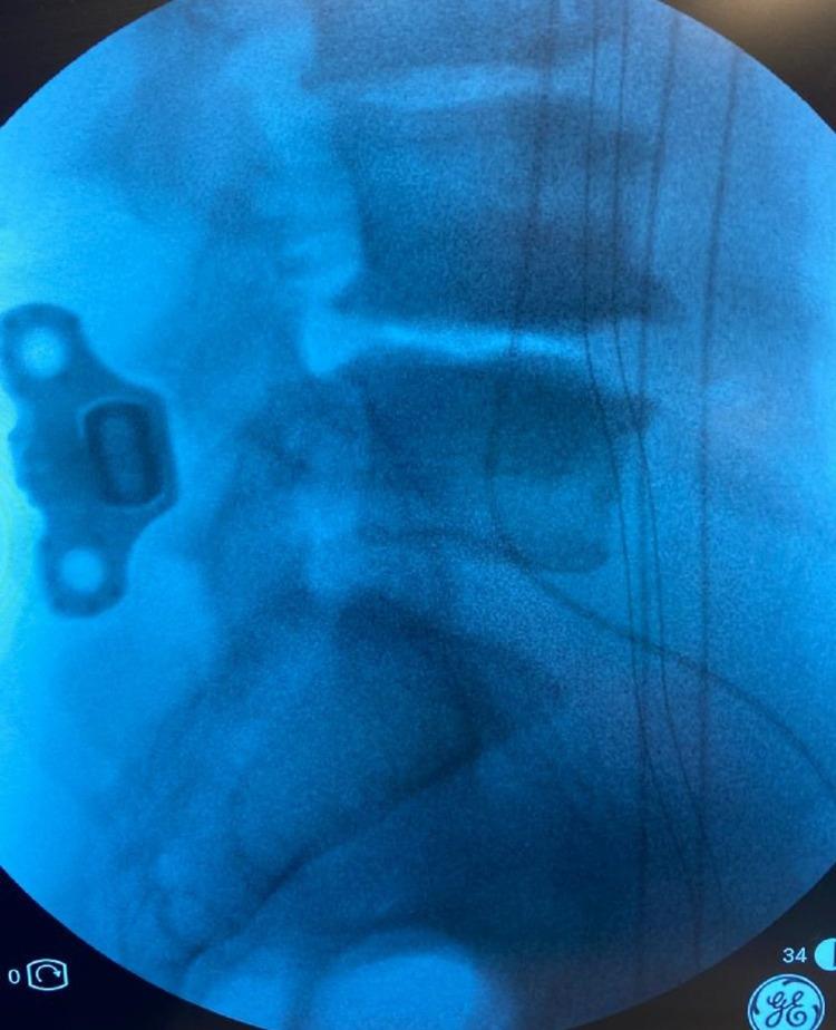 https://cdn.ncbi.nlm.nih.gov/pmc/blobs/857a/8713432/48faeda696cb/cureus-0013-00000019956-i04.jpg