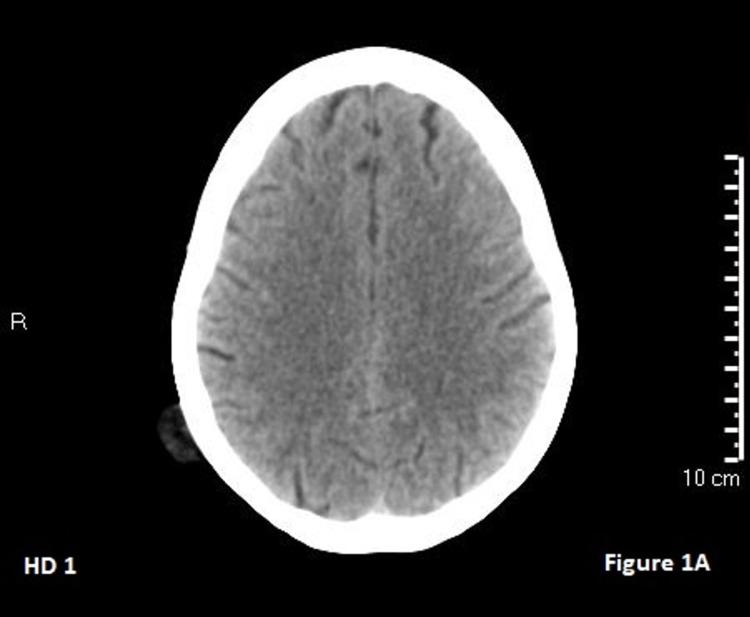 https://cdn.ncbi.nlm.nih.gov/pmc/blobs/8580/8942087/c703e33611a6/cureus-0014-00000022454-i01.jpg