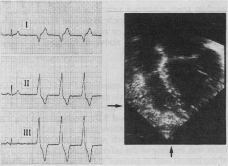 https://cdn.ncbi.nlm.nih.gov/pmc/blobs/85cb/1276897/343d9102dabc/brheartj00077-0056-a.jpg