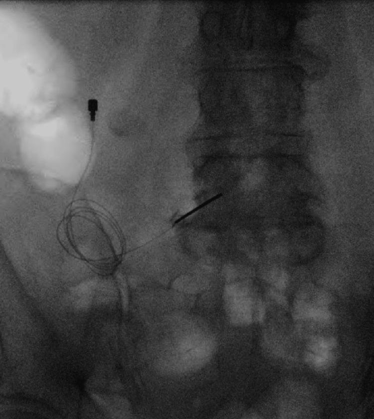 https://cdn.ncbi.nlm.nih.gov/pmc/blobs/85d6/11571276/9b1285db23ea/cureus-0016-00000071850-i04.jpg