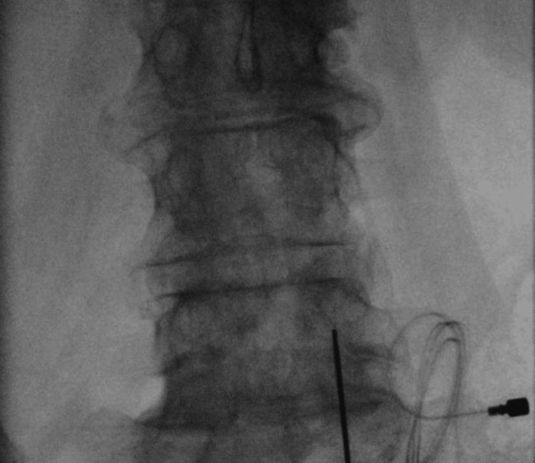 https://cdn.ncbi.nlm.nih.gov/pmc/blobs/85d6/11571276/ce0f53ad342a/cureus-0016-00000071850-i03.jpg