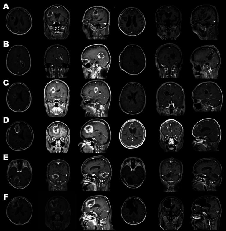 https://cdn.ncbi.nlm.nih.gov/pmc/blobs/85eb/10160401/ef8321cdb77e/fneur-14-1170045-g004.jpg
