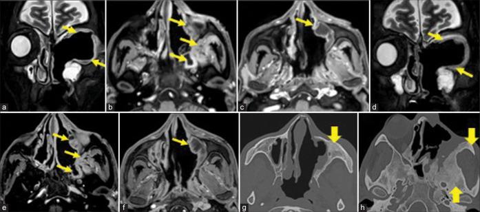 https://cdn.ncbi.nlm.nih.gov/pmc/blobs/8623/10481822/1e433fc88e7e/JCIS-13-23-g010.jpg