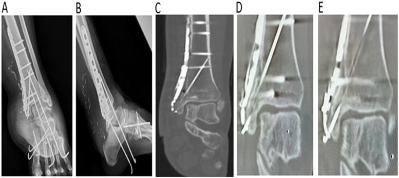 https://cdn.ncbi.nlm.nih.gov/pmc/blobs/8628/12034624/c1c8a53c6381/fsurg-12-1553498-g003.jpg