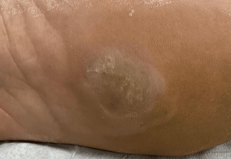https://cdn.ncbi.nlm.nih.gov/pmc/blobs/8677/11530243/4dbf67832048/cureus-0016-00000070680-i02.jpg