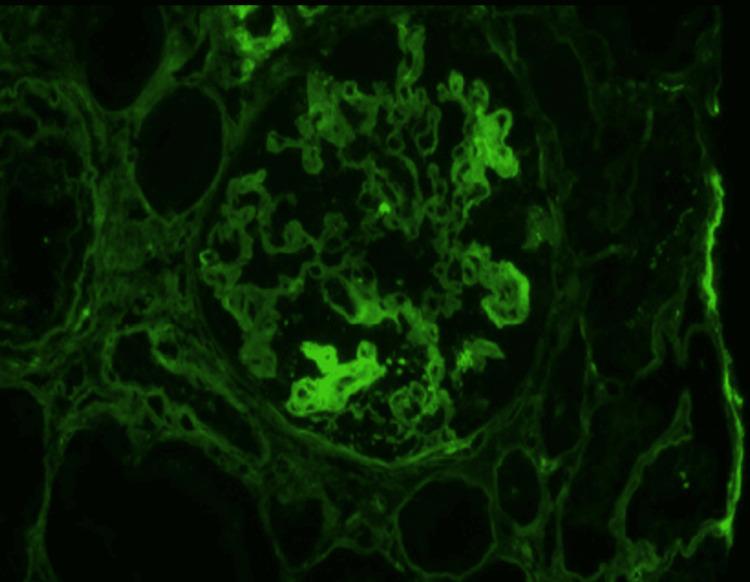 https://cdn.ncbi.nlm.nih.gov/pmc/blobs/867b/10918209/a04ab91bef14/cureus-0016-00000053669-i03.jpg