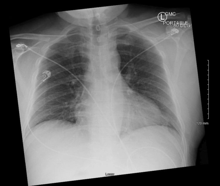 https://cdn.ncbi.nlm.nih.gov/pmc/blobs/8683/12143929/1f8d2866b42c/cureus-0017-00000083608-i02.jpg