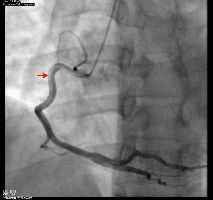 https://cdn.ncbi.nlm.nih.gov/pmc/blobs/8683/12143929/b423082b26d8/cureus-0017-00000083608-i06.jpg
