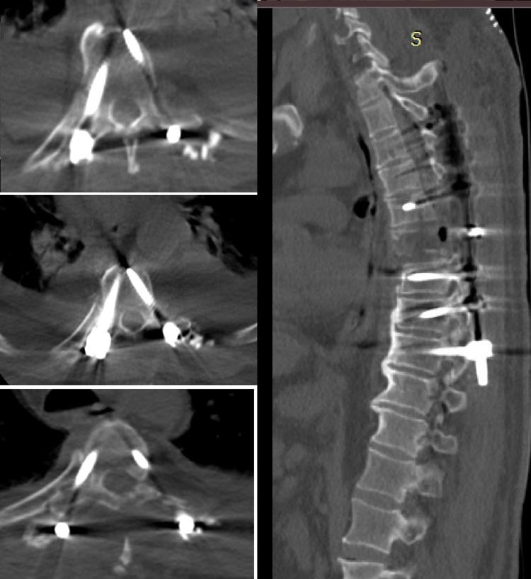https://cdn.ncbi.nlm.nih.gov/pmc/blobs/869f/7978149/2e3d24678484/cureus-0013-00000013989-i04.jpg