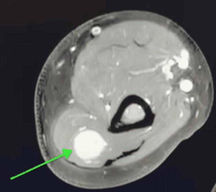 https://cdn.ncbi.nlm.nih.gov/pmc/blobs/86a6/12008818/d1a71e2781fc/cureus-0017-00000080865-i02.jpg