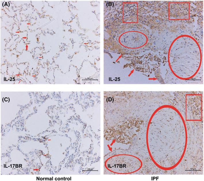 https://cdn.ncbi.nlm.nih.gov/pmc/blobs/86ea/9629992/5caa643f5bbe/CRJ-16-696-g002.jpg