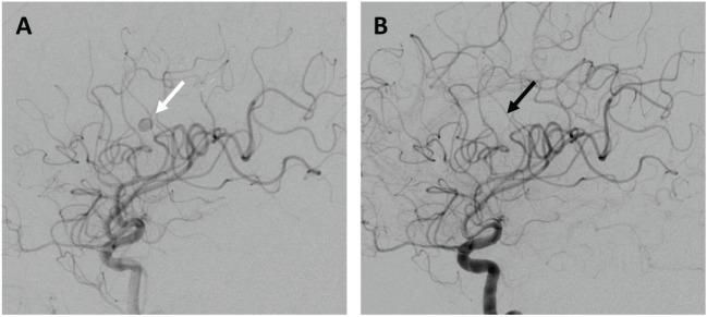 https://cdn.ncbi.nlm.nih.gov/pmc/blobs/86f6/4943964/5d228a81ed3b/fneur-07-00112-g003.jpg