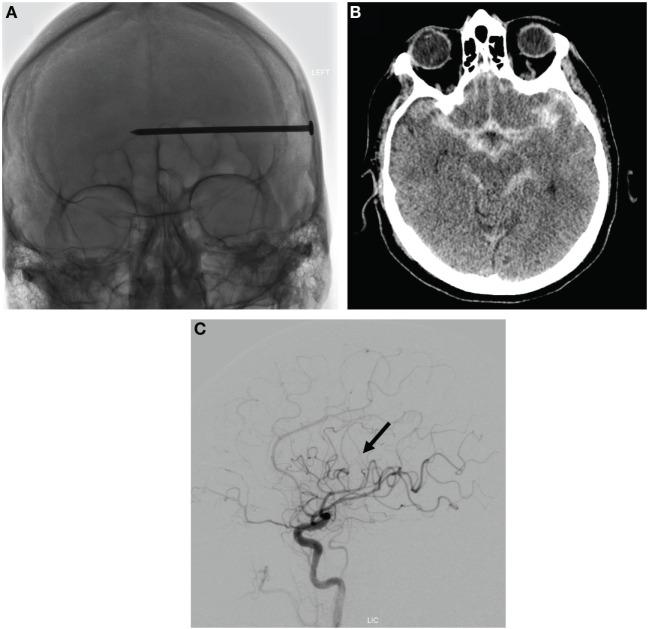 https://cdn.ncbi.nlm.nih.gov/pmc/blobs/86f6/4943964/a3a639742b9c/fneur-07-00112-g001.jpg