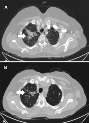 https://cdn.ncbi.nlm.nih.gov/pmc/blobs/871d/5900732/de6f648da752/CNCR-124-1358-g004.jpg