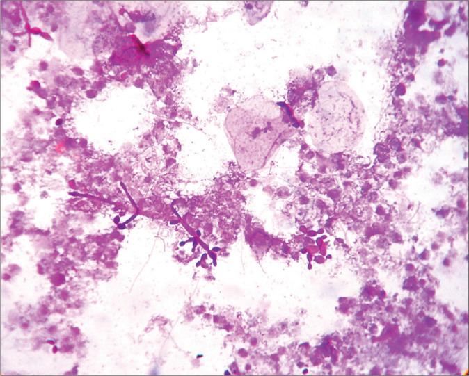https://cdn.ncbi.nlm.nih.gov/pmc/blobs/8752/9345103/908e0efb3470/Cytojournal-19-44-g007.jpg