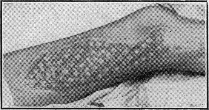 https://cdn.ncbi.nlm.nih.gov/pmc/blobs/87d4/2283057/fc9361a7af88/brmedj03994-0011-a.jpg