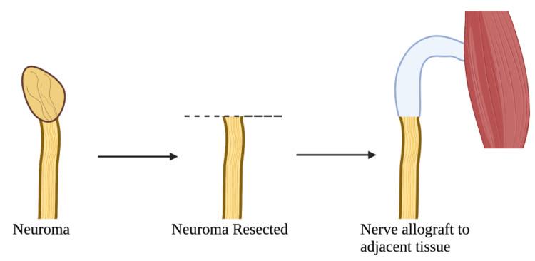 https://cdn.ncbi.nlm.nih.gov/pmc/blobs/880d/10292632/fd3c9bcab81f/cureus-0015-00000039567-i01.jpg