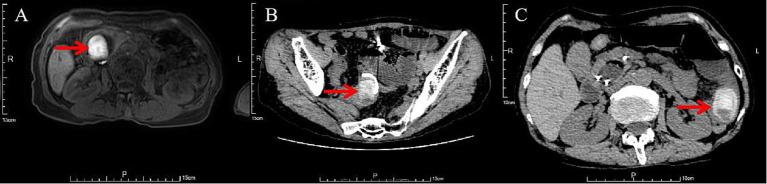 https://cdn.ncbi.nlm.nih.gov/pmc/blobs/8827/12263398/5e4349c78c77/fmed-12-1604835-g001.jpg