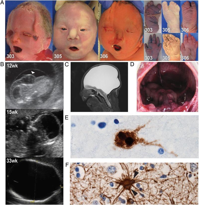 https://cdn.ncbi.nlm.nih.gov/pmc/blobs/882f/5502313/1e68cebe25ce/jmedgenet-2016-104296f01.jpg