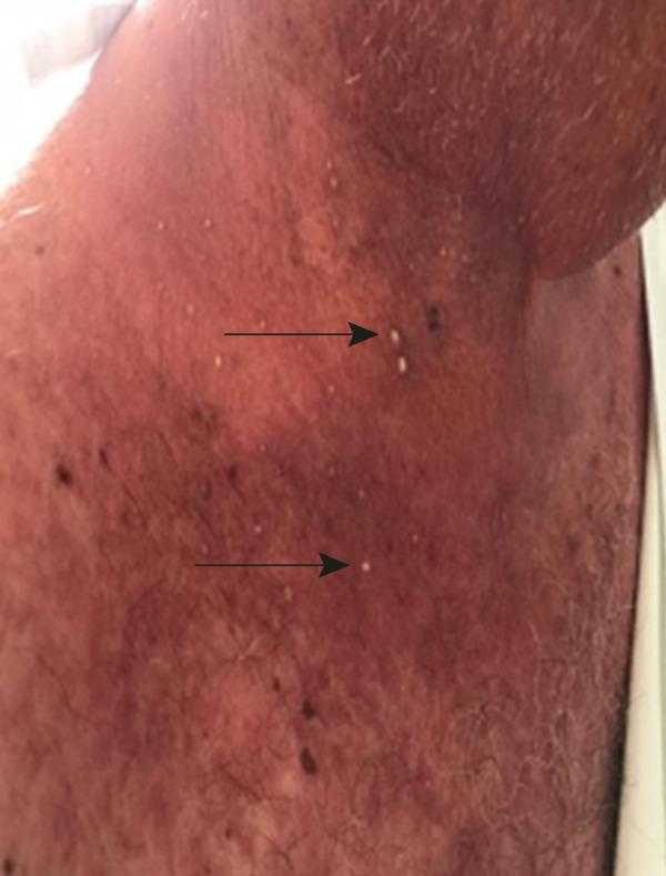 https://cdn.ncbi.nlm.nih.gov/pmc/blobs/883a/8042418/6d05ee36edc4/amjcaserep-22-e928930-g005.jpg