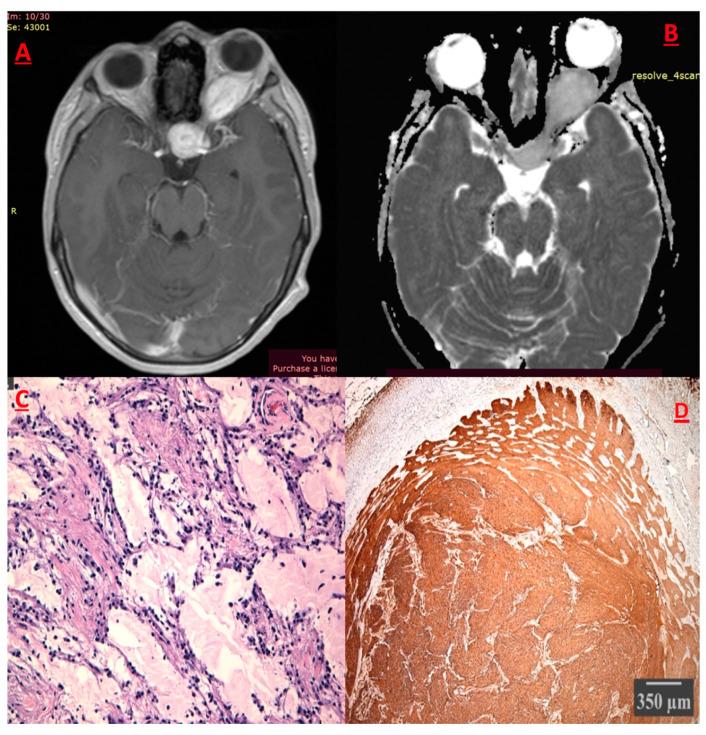 https://cdn.ncbi.nlm.nih.gov/pmc/blobs/8852/12071314/69eac6e6fef5/cancers-17-01566-g005.jpg