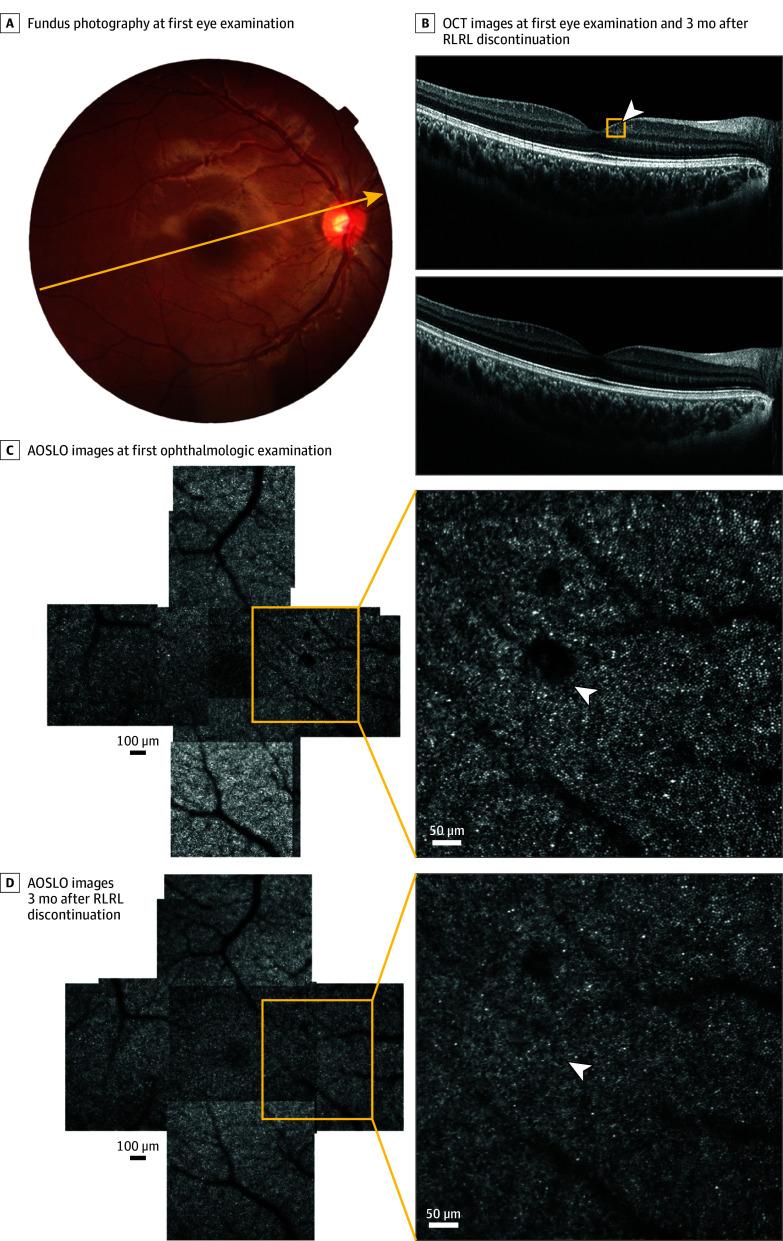 https://cdn.ncbi.nlm.nih.gov/pmc/blobs/886a/12022868/279d0a370b01/jamaophthalmol-e250835-g003.jpg